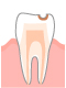 C1：エナメル質の虫歯 