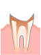 C4：歯根まで進行した虫歯