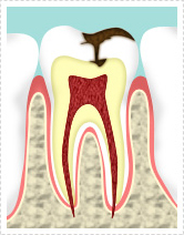 虫歯・根管治療